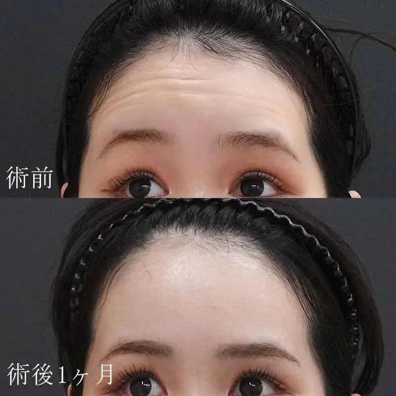 額のボトックス注射の症例写真