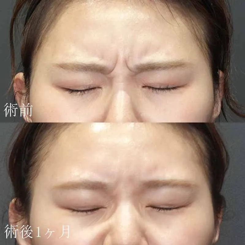 眉間のボトックス注射の症例写真