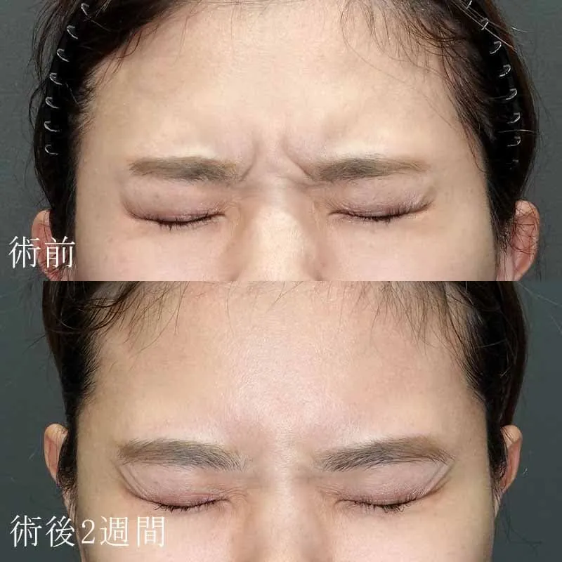 眉間のボトックス注射の症例写真
