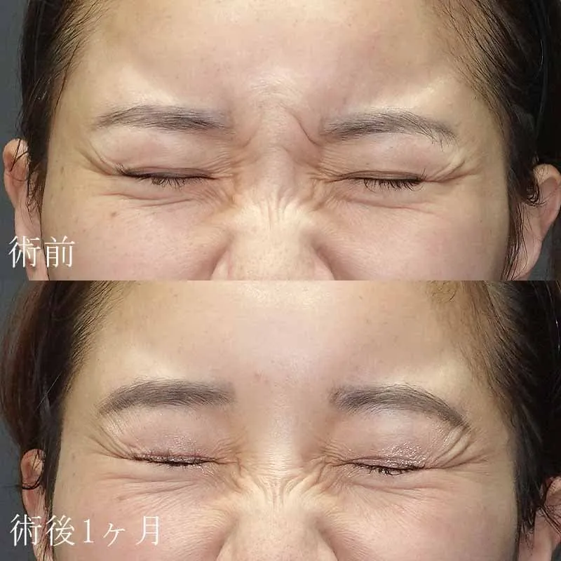 鼻横（バニーライン）のボトックス注射の症例写真