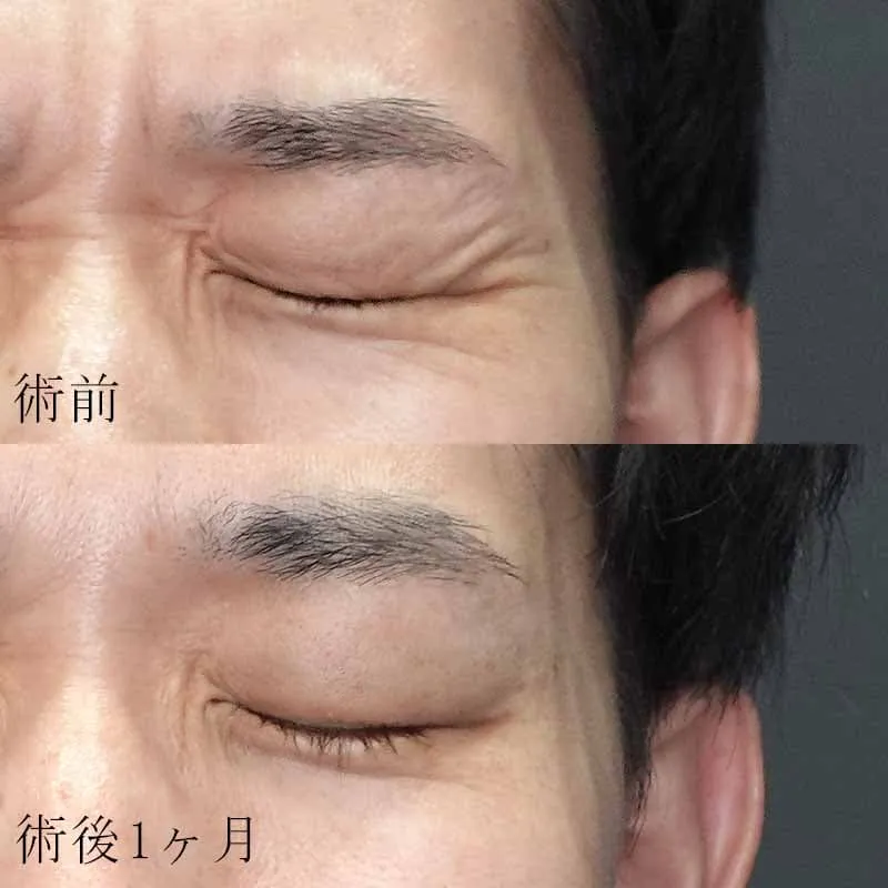 目尻のボトックス注射の症例写真