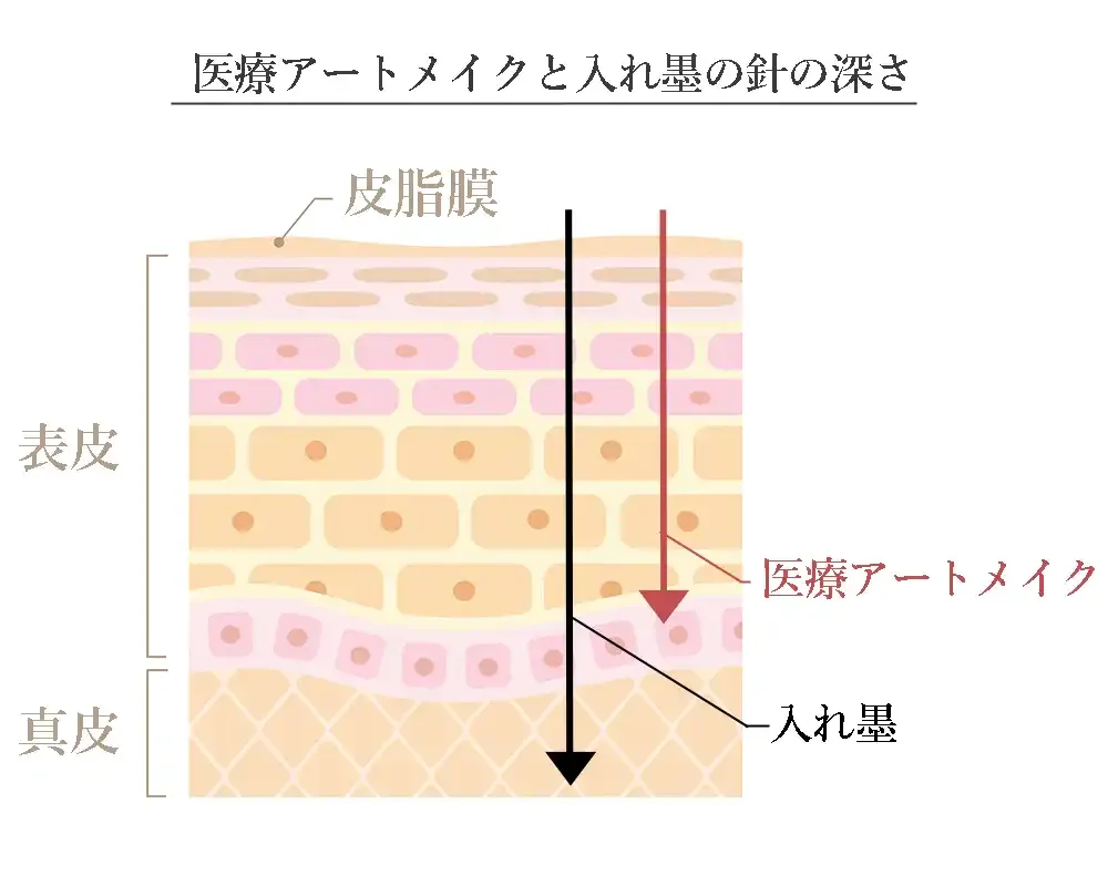 医療アートメイクと入れ墨の針の深さ