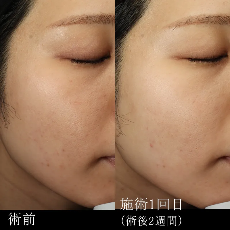 肌質改善の症例写真