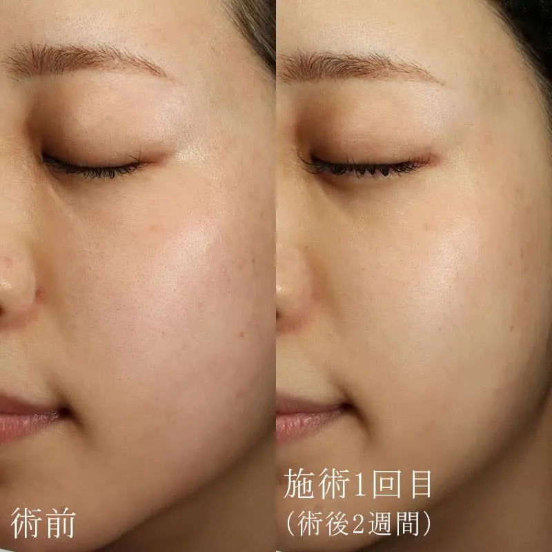 肌質改善の症例写真