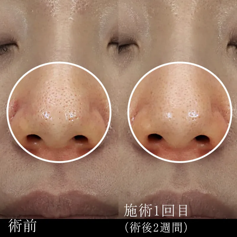 毛穴の改善の症例写真