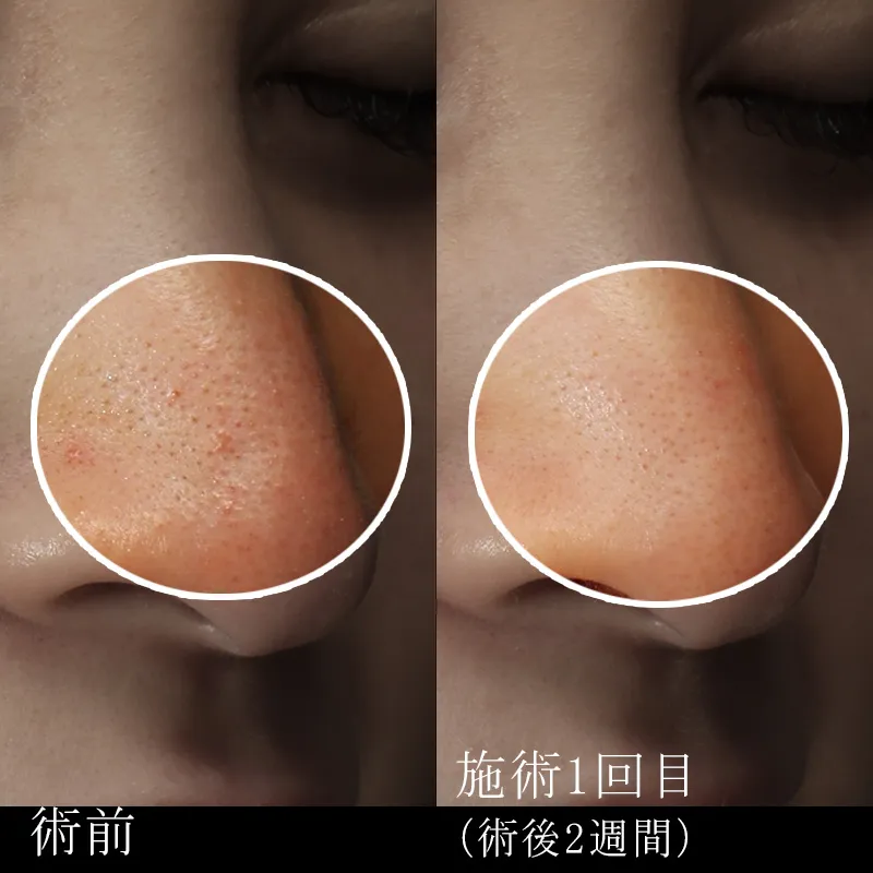 毛穴の改善の症例写真