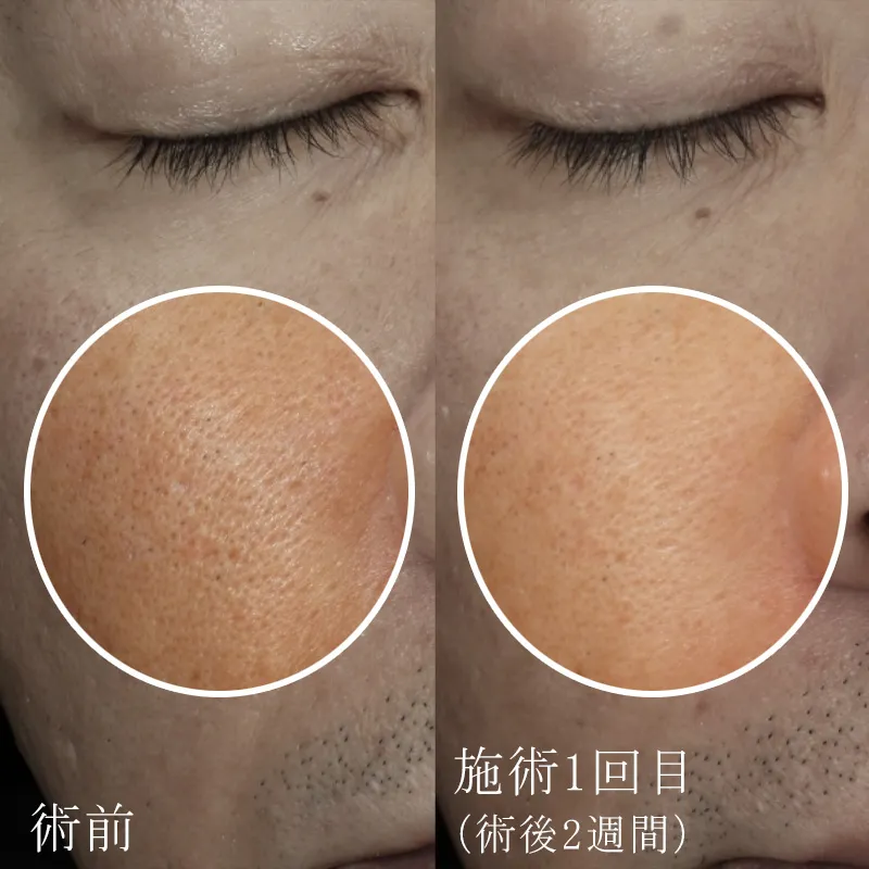 たるみ毛穴の改善の症例写真