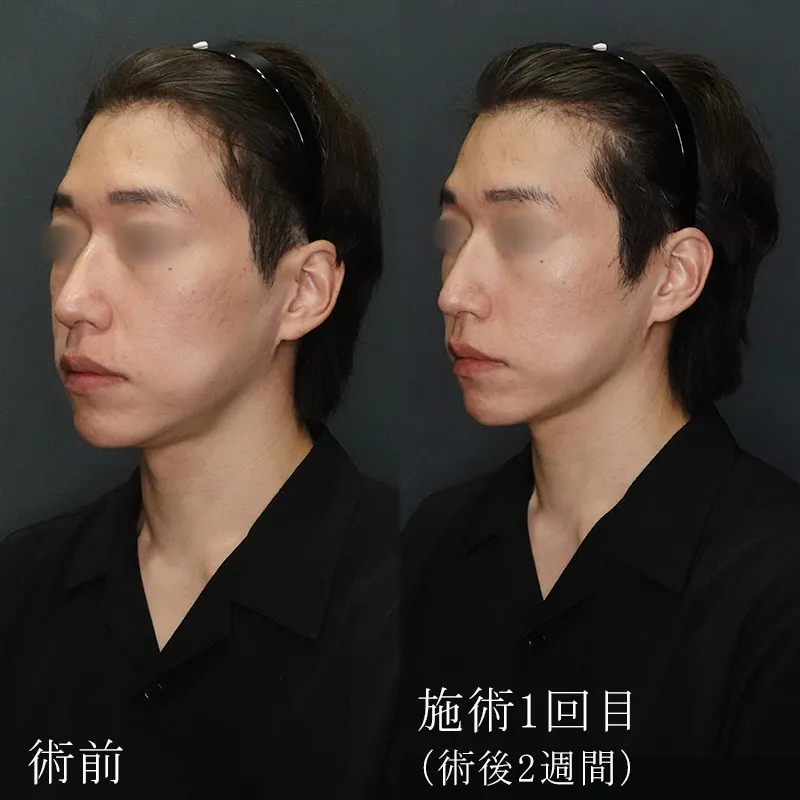 タイトニング効果の症例写真