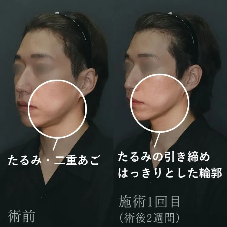 ブレッシングによるたるみ改善効果