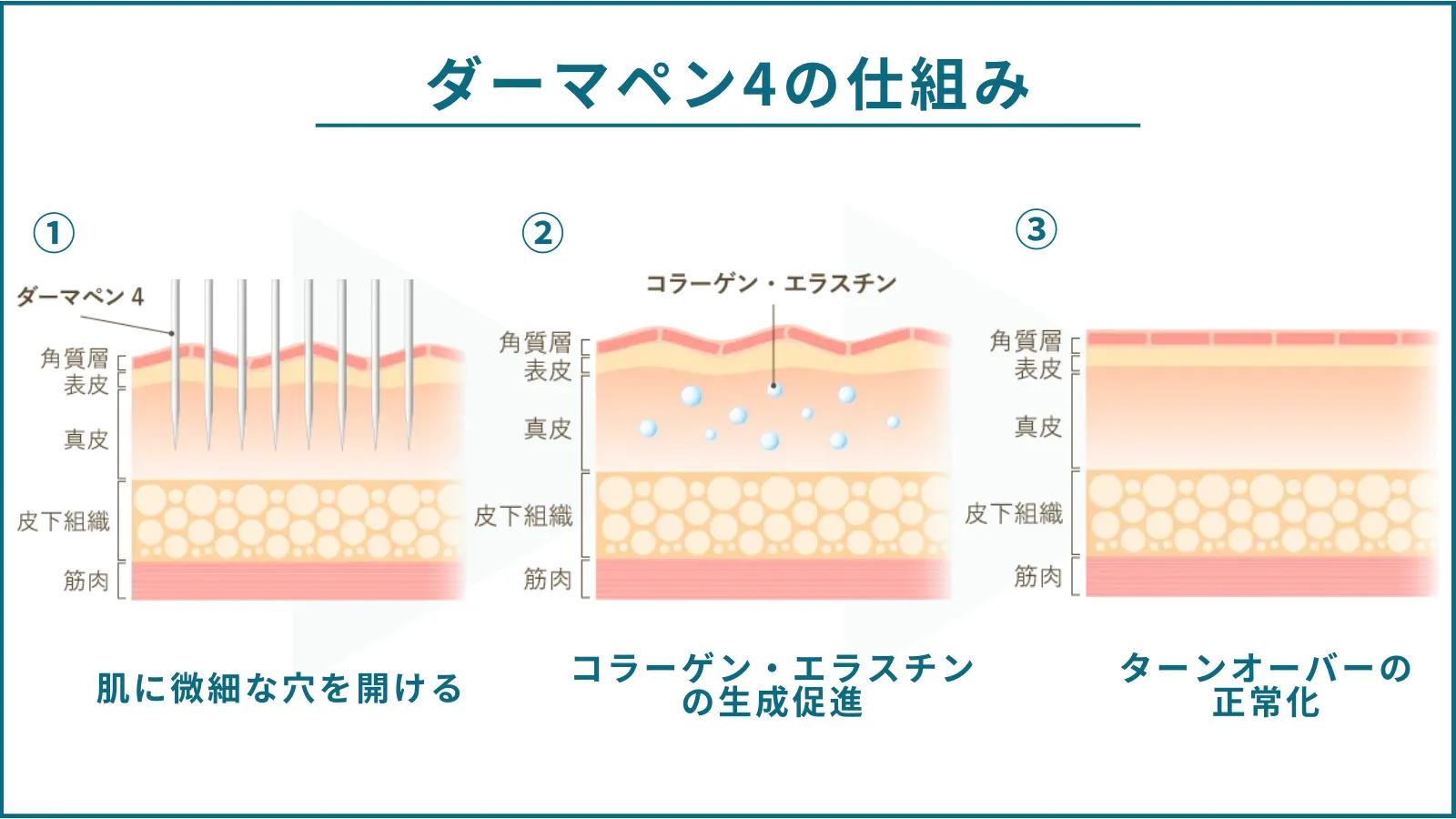 ダーマペン4の仕組み