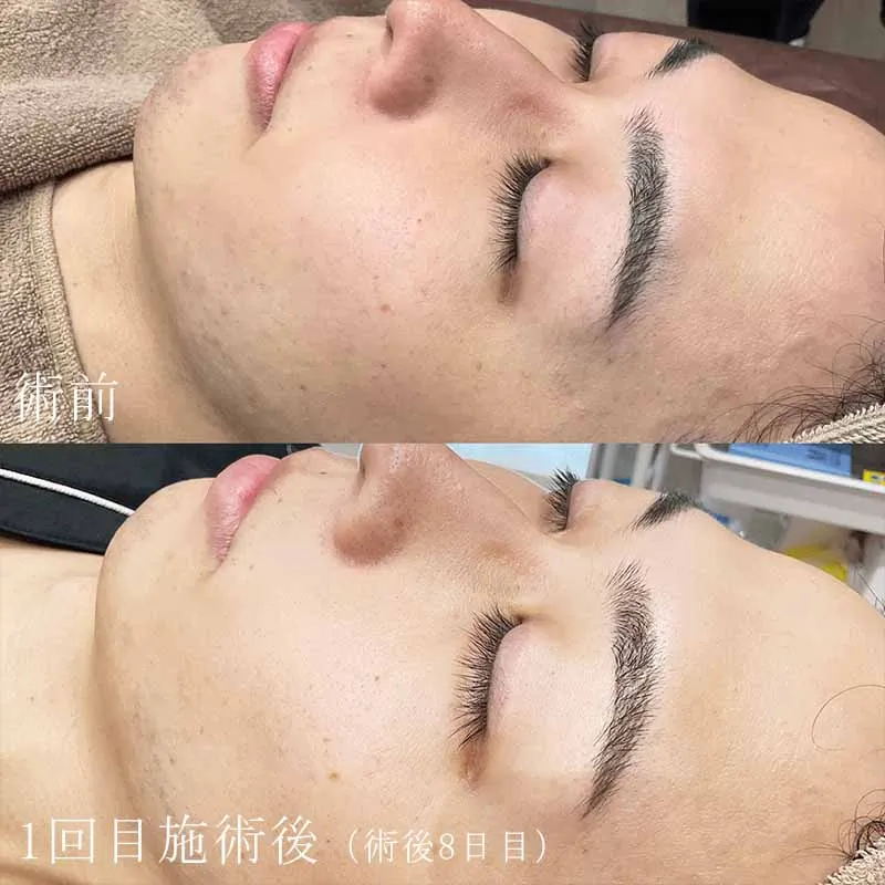 ヴェルベットスキンの症例写真