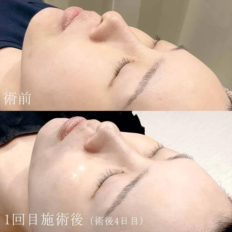 ヴェルベットスキンの症例写真