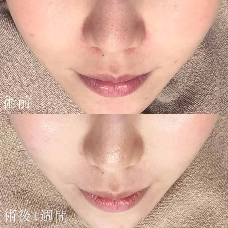 ヴェルベットスキンの症例写真