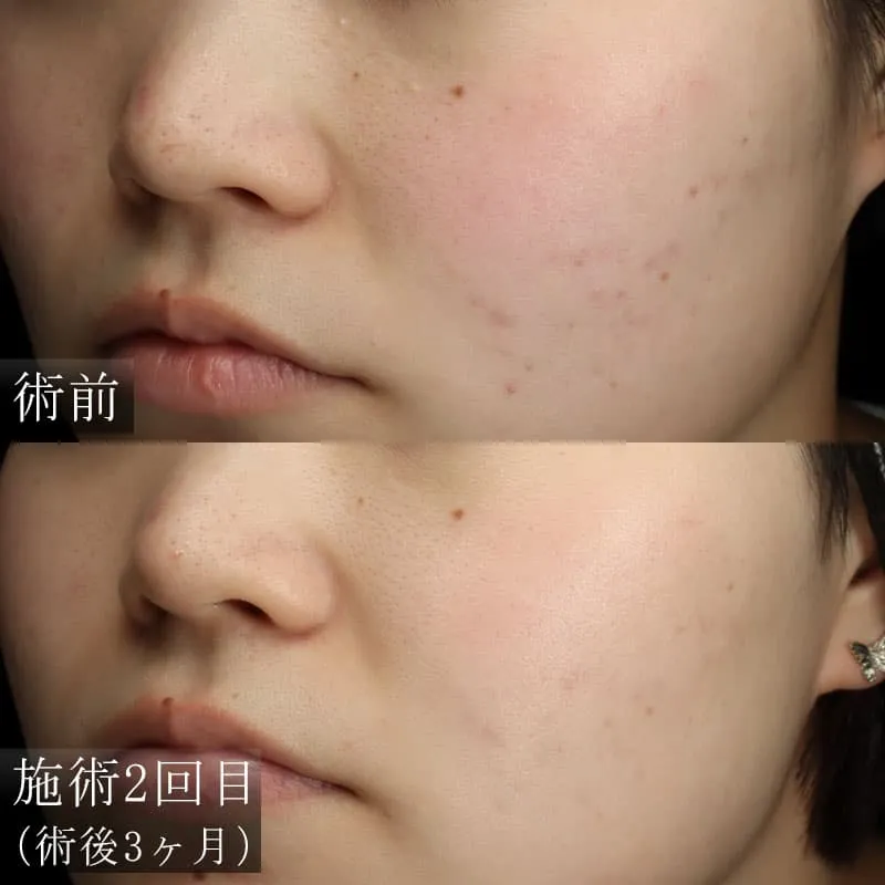 ダーマペン4の症例写真