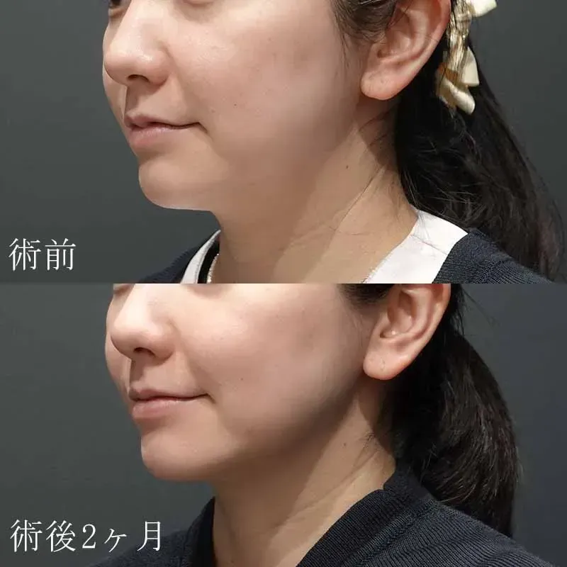 医療用ハイフの症例写真