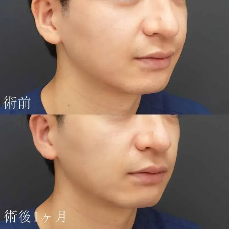 医療用ハイフの症例写真