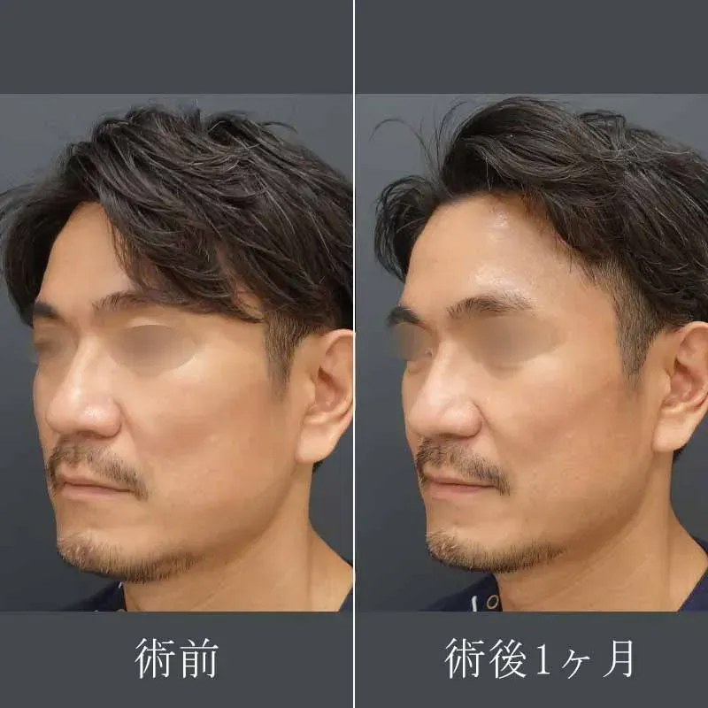 医療用ハイフの症例写真