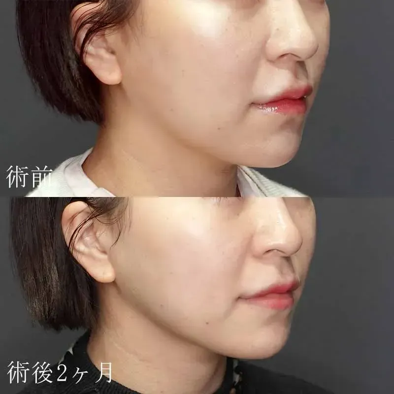 医療用ハイフの症例写真