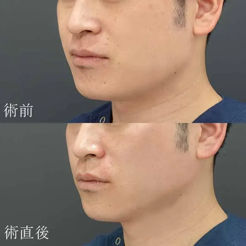 医療用ハイフの症例写真