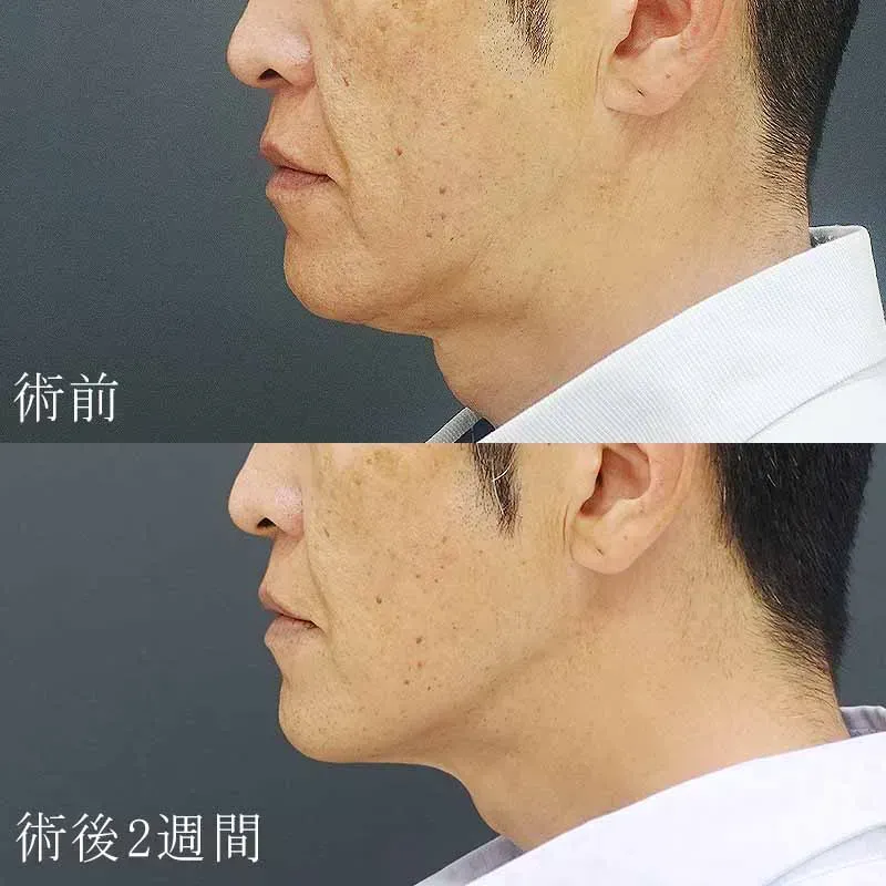 医療用ハイフの症例写真