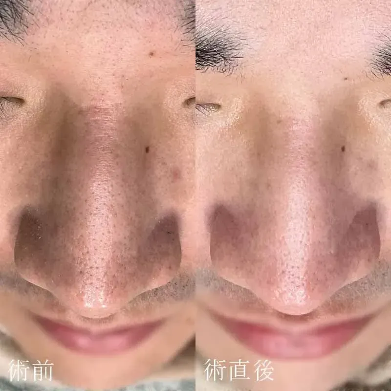 ハイドラブースターの症例写真