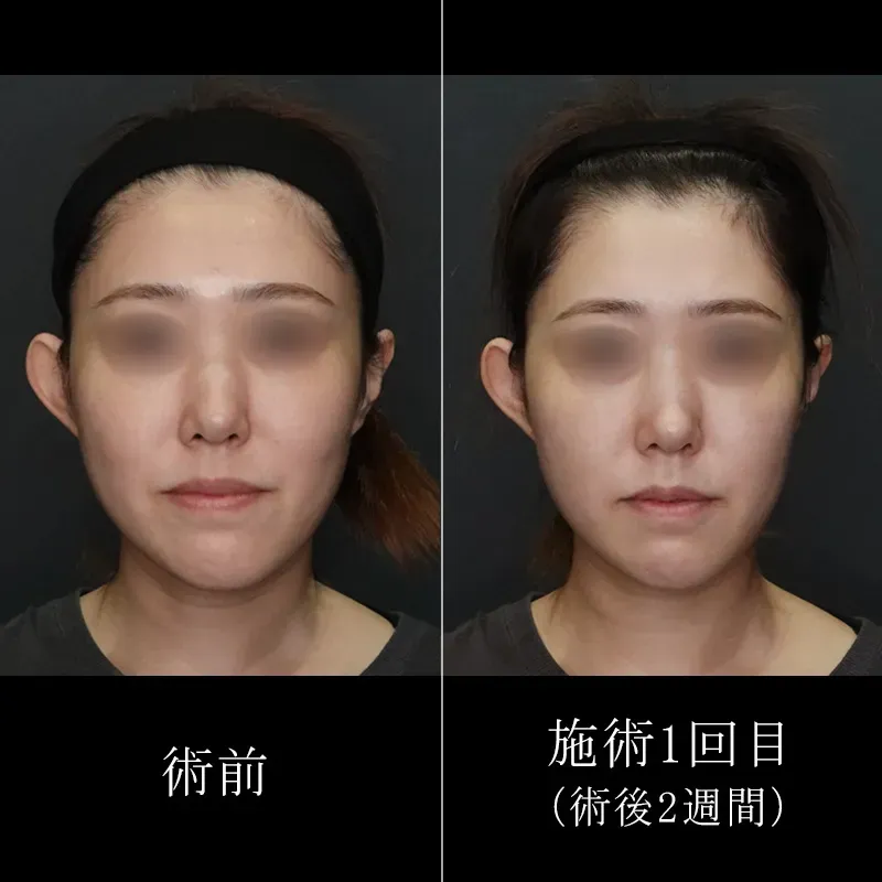 ブレッシングの症例写真①