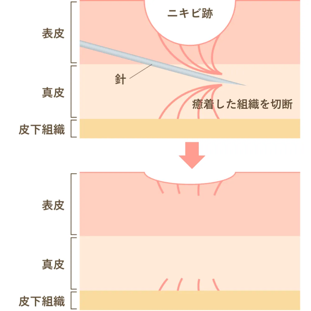 サブシジョン