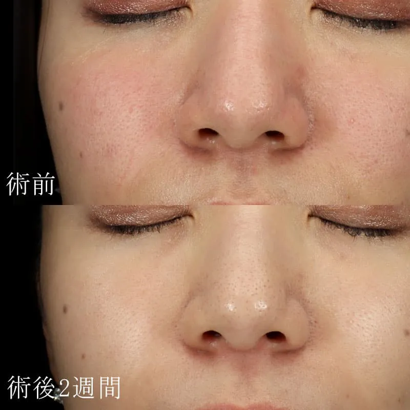 マイクロボトックスの脂肪吸引の症例写真