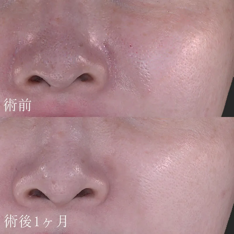 マイクロボトックスの症例写真