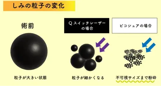 ピコレーザーと他レーザー治療との違い