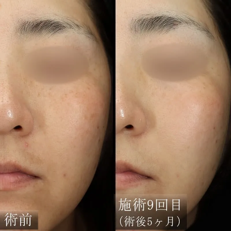 ピコシュアの症例写真