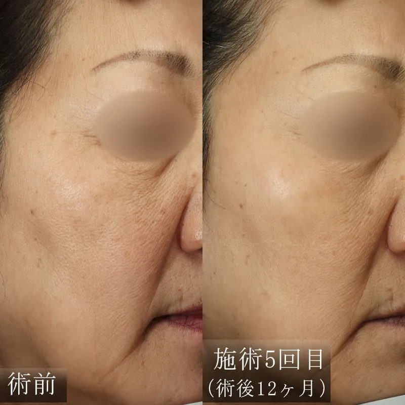 ピコシュアの症例写真