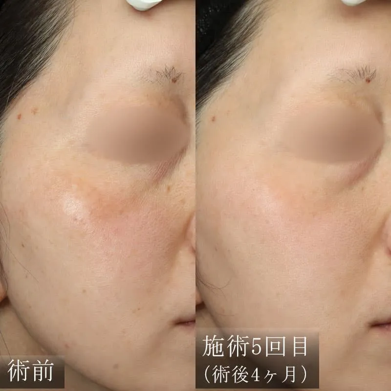 ピコシュアの症例写真