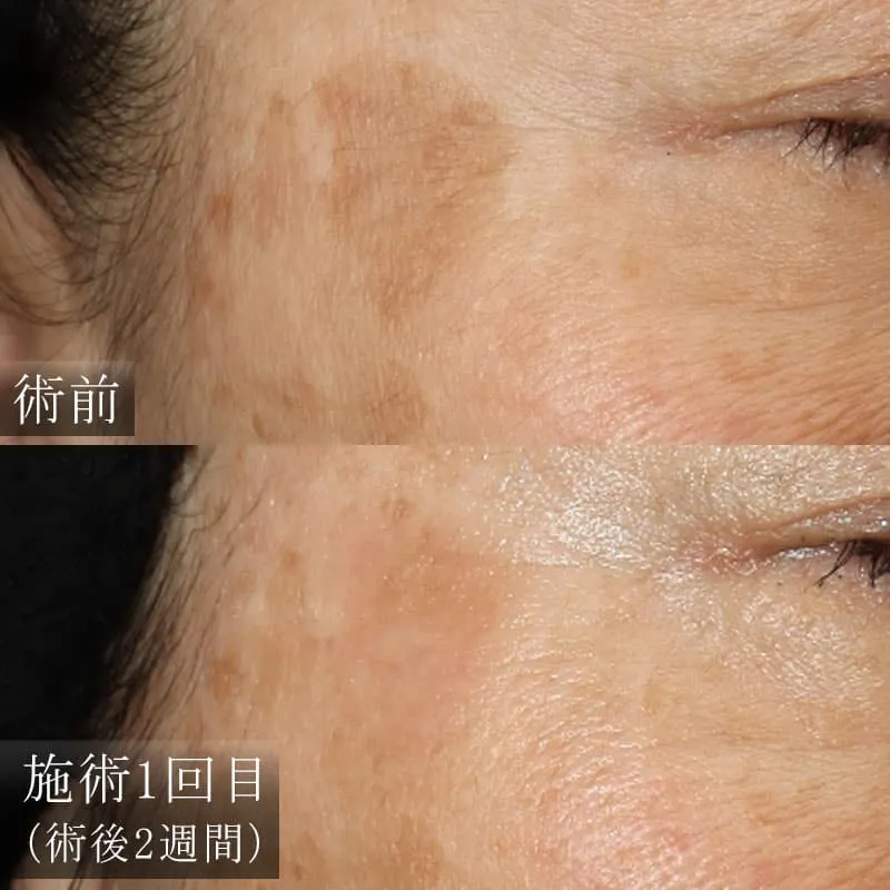 ピコスポットの症例写真