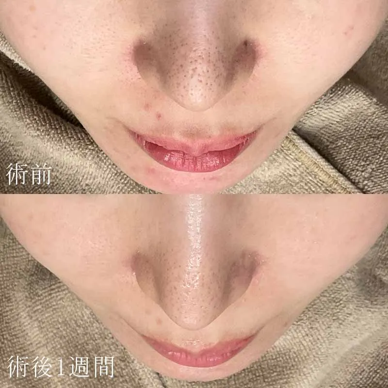 ピコトーニング+フラクショナルの症例写真