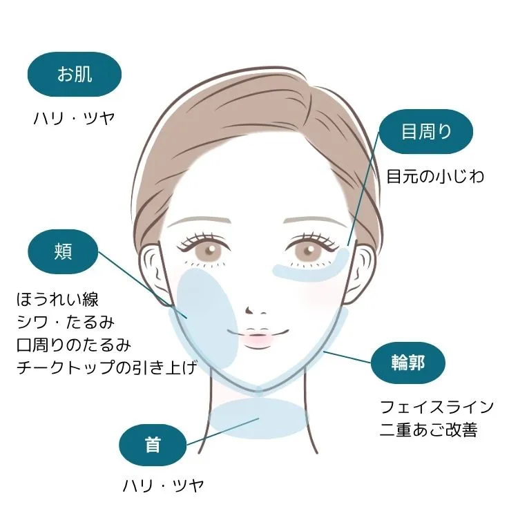 マイクロボトックスの注入箇所