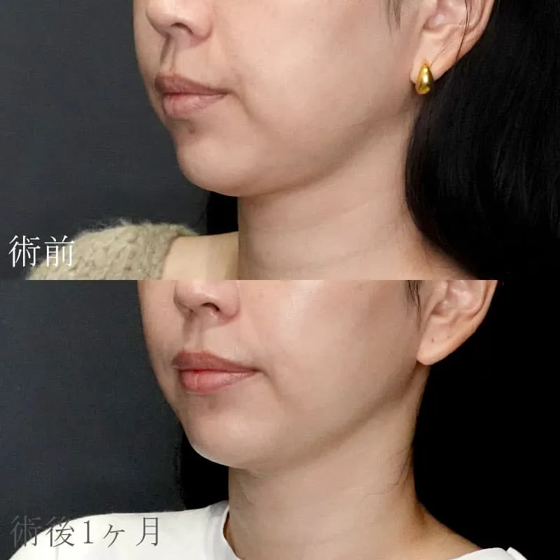 ボルニューマの症例写真