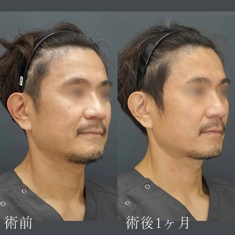 ボルニューマの症例写真