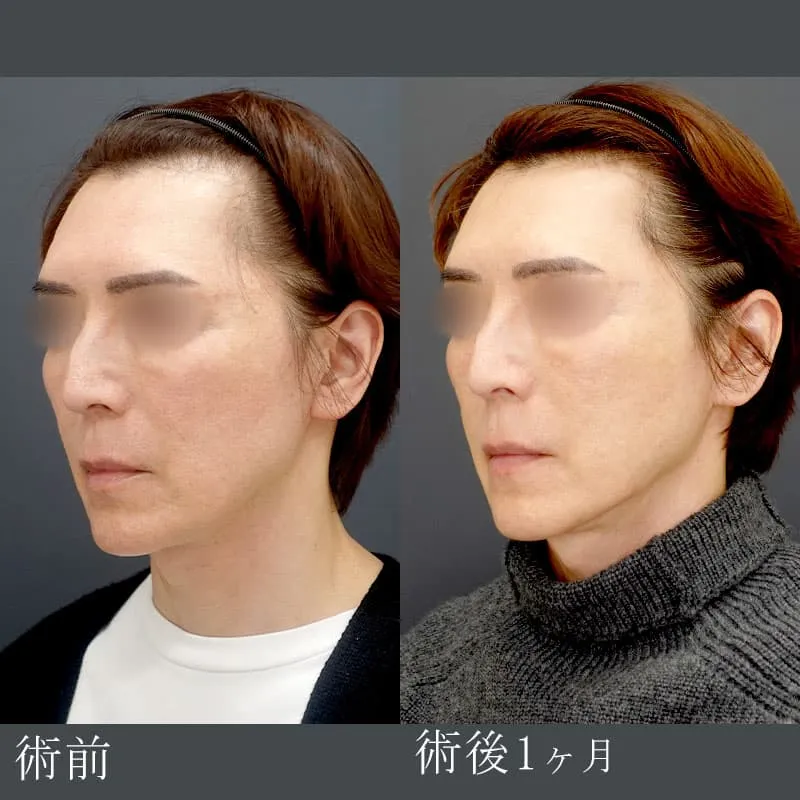 ボルニューマの症例写真