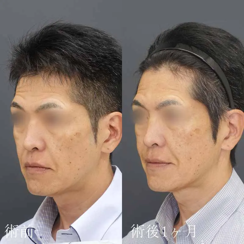 ボルフォーマーの症例写真
