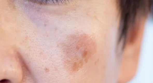 隠れたシミや肝斑を見つけ、不適切な治療による悪化を防ぐ