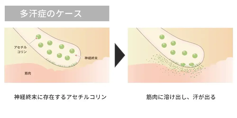 多汗症の場合