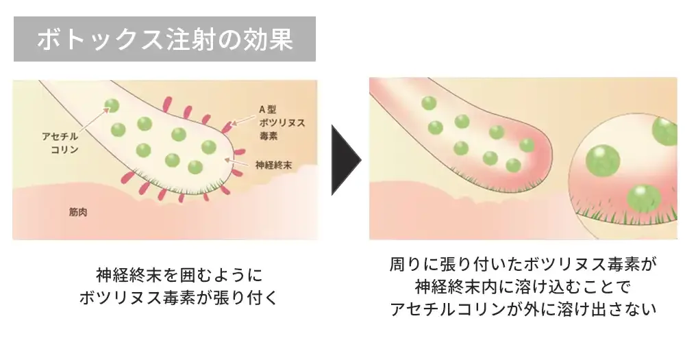 ボトックス注射の効果