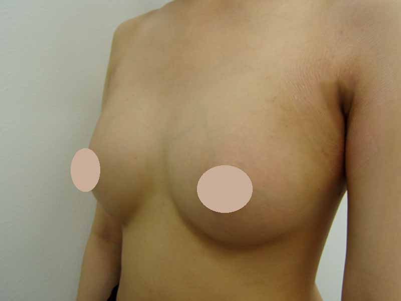 Breast augmentation220cc_2__takee_20100324