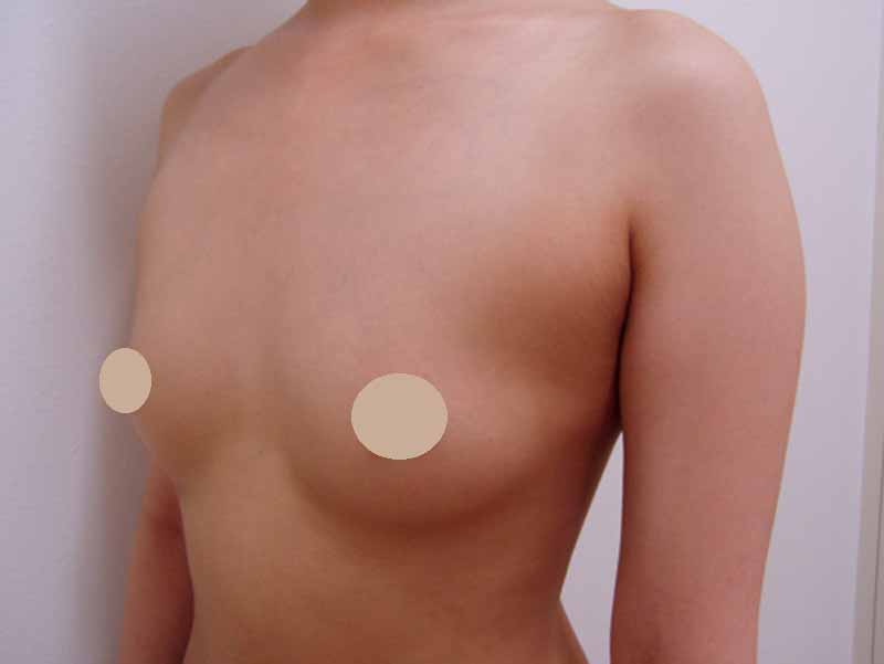 Breast augmentation220cc_3_takee_20100324