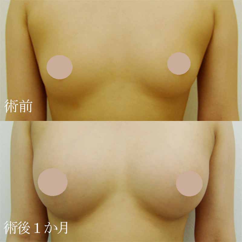 Breast augmentation220cc_takee_20100324