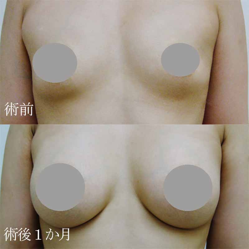 Breast augmentation_1_20100325_240cc