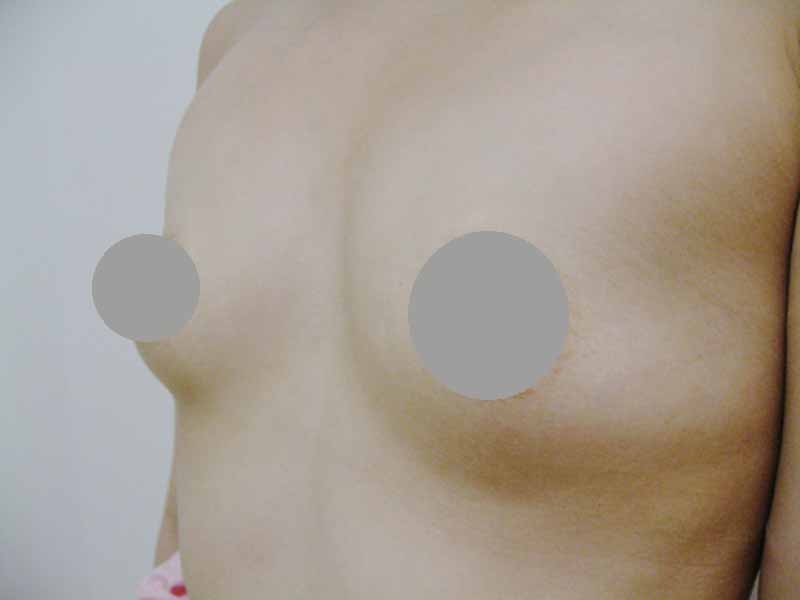 Breast augmentation_2_20100325_240cc