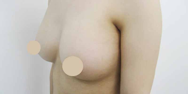Breast augmentation_3_20100319＿200cc
