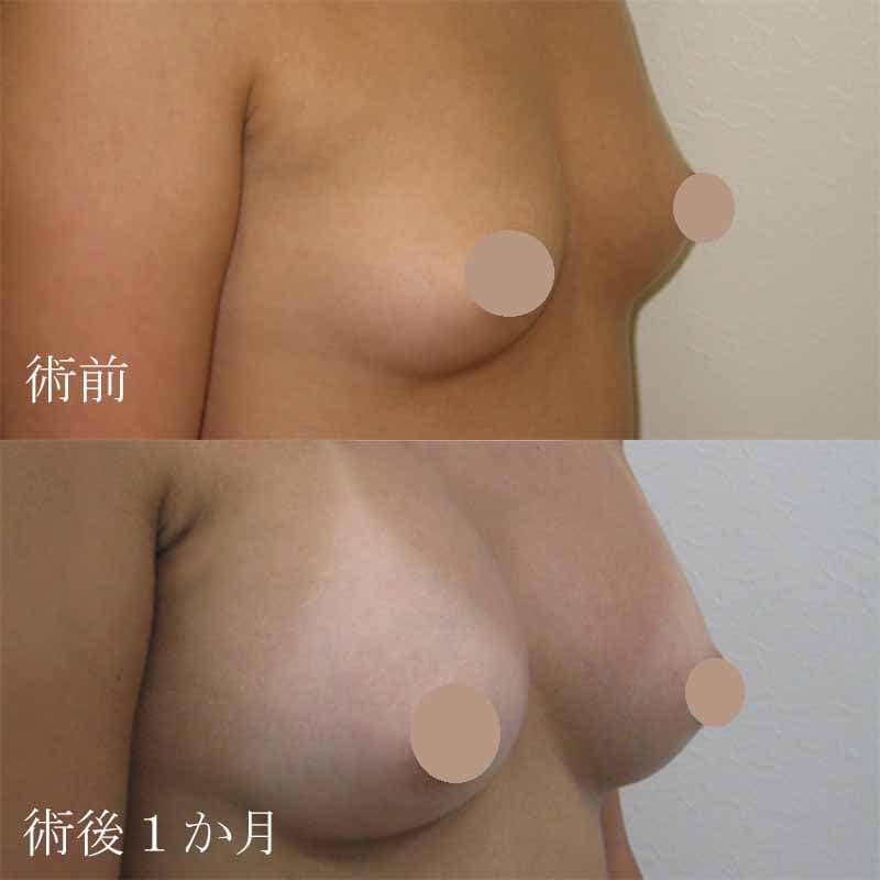 Breast augmentation240cc_1_takee_20100403